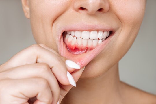 Mouth Ulcers: Causes, Remedies, and Care