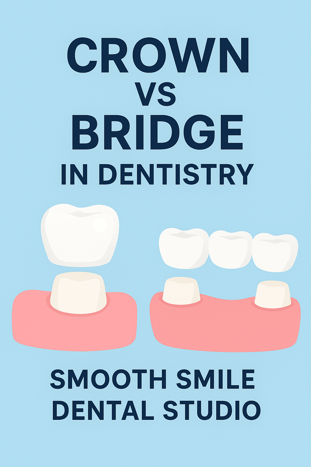 Crown vs Bridge in Dentistry – What’s the Difference?