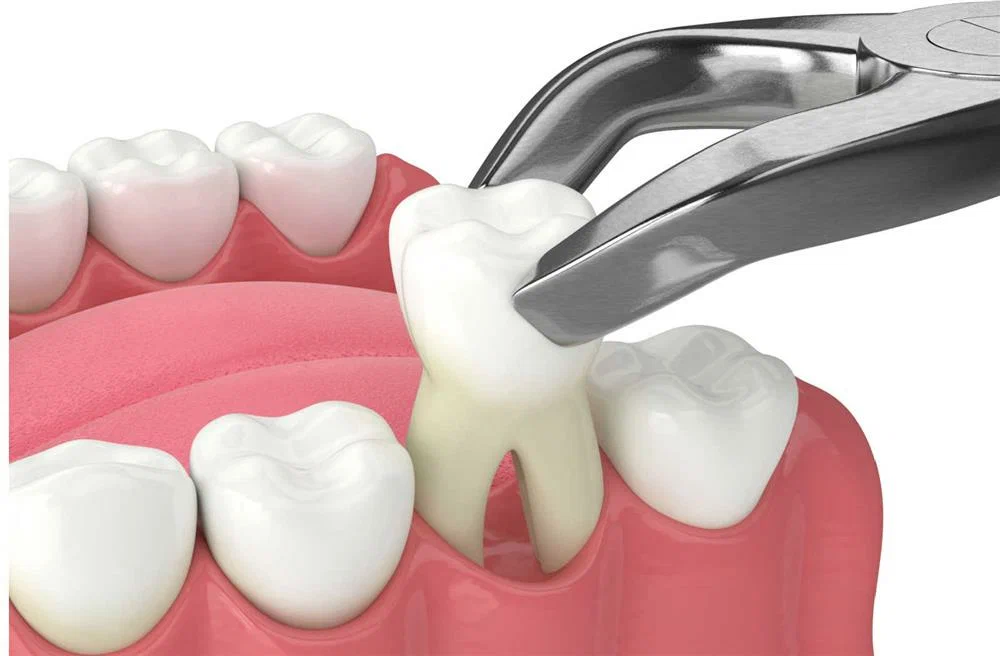 Why Replace a Tooth After Extraction?